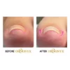 Ingrown Nail Therapy Orthonyx 15ml