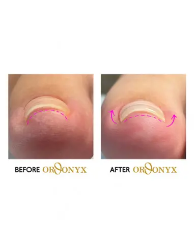 Ingrown Nail Therapy Orthonyx 15ml